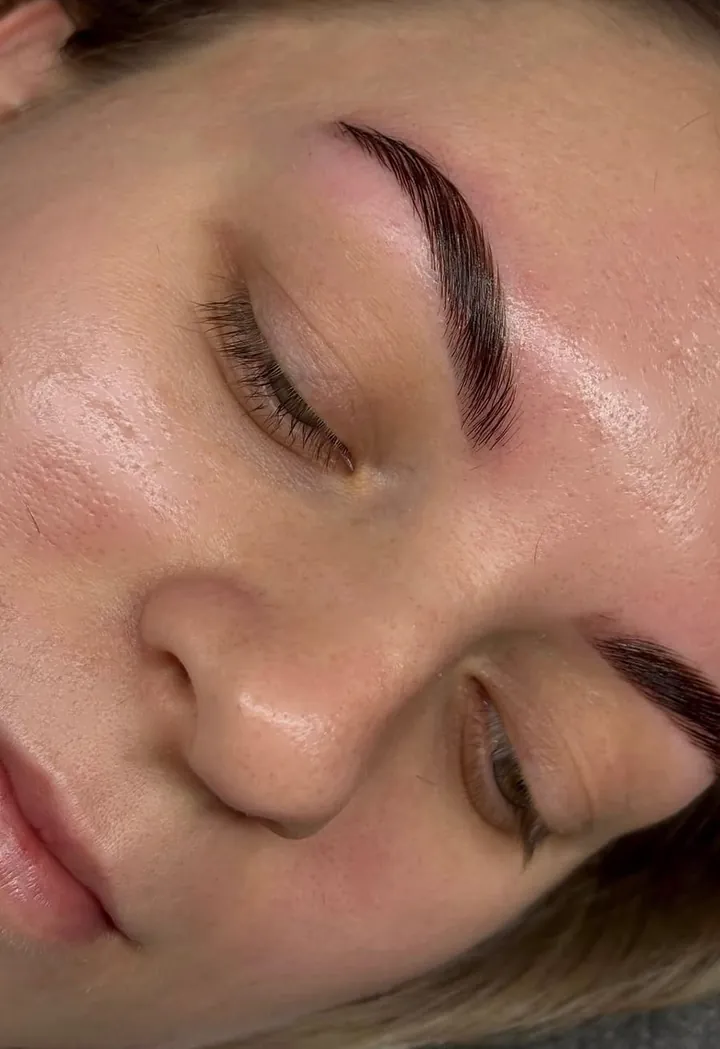 Brow lift Osijek — njega nakon tretmana